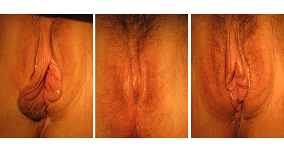 Labiaplasty Before & After 03.17_003