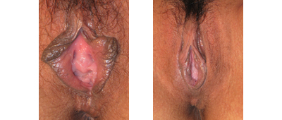 Before and After Vaginoplasty