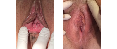 Perineoplasty Before and After