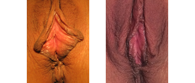 Before and After Perineoplasty