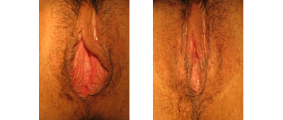Pre and 1 month post-op LP, hood, perineoplasty and vaginoplasty