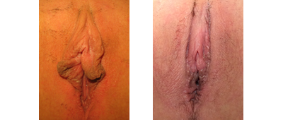 Pre- and 1 month post-op labiaplasty, hood reduction, V-Y wedge