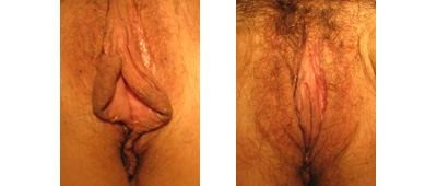 Before and After Labiaplasty