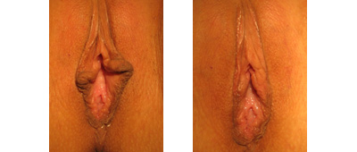 Before and After Labiaplasty