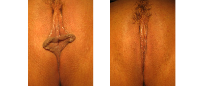 Before and After Labiaplasty