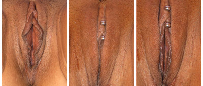 Before and After Labiaplasty