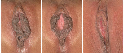 Before and After Labiaplasty