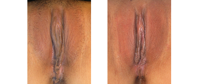 Before and After Labiaplasty