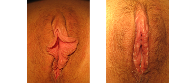 Before and After Labiaplasty Surgery