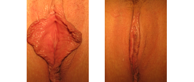 Labiaplasty Results