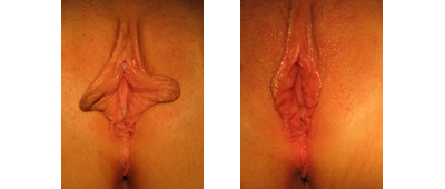 Before and After Labiaplasty