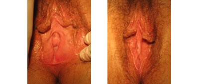 Before and After Perineoplasty