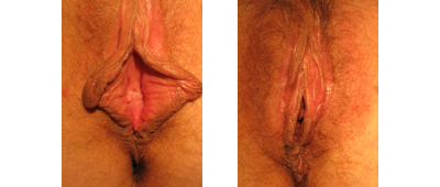 Before and After Labiaplasty