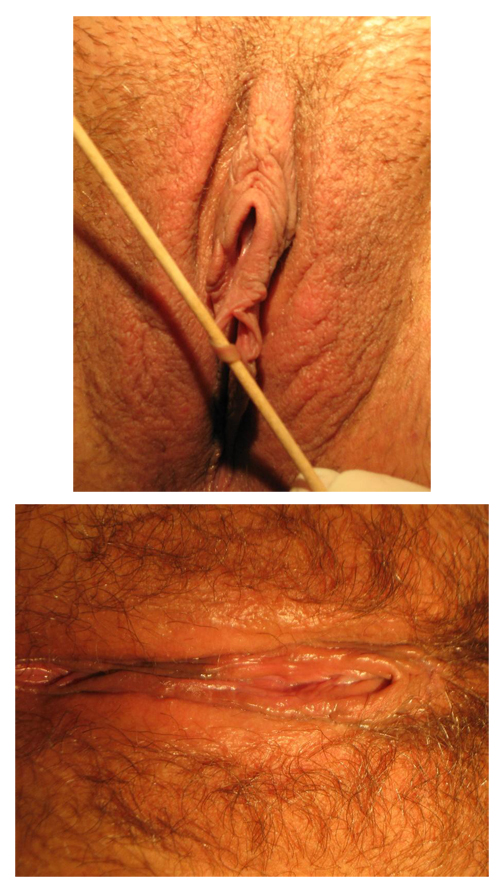 Fistulas in V-wedge labiaplasty