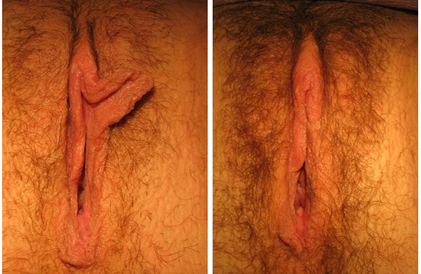 A carefully designed curvilinear resection was perfect for this woman who desired her hypertrophic left labum to as much as possible match the right side.
