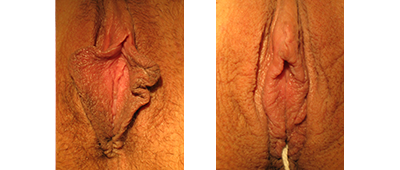 Linear labiaplasty