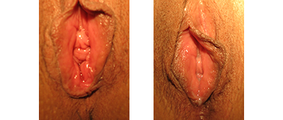 Perineoplasty | Vaginoplasty