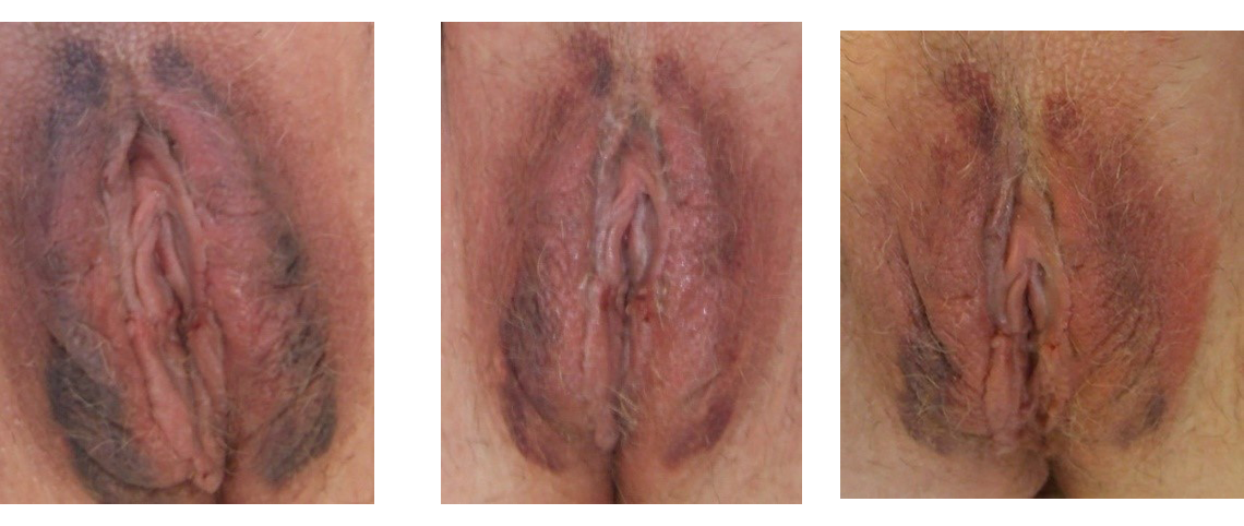 Labiaplasty Recovery Photos