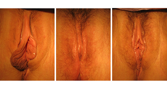 Labiaplasty-results