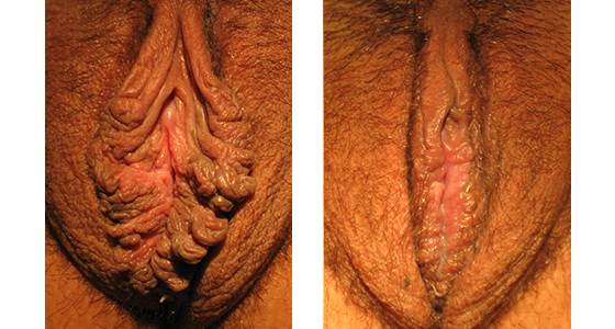 Labiaplasty Revision Before and After