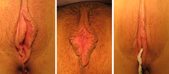 labiaplasty_results_08-001-1