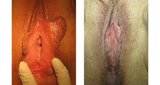 vaginoplasty_results_08-003