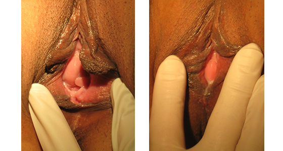 Before and After Perineoplasty and Vaginoplasty