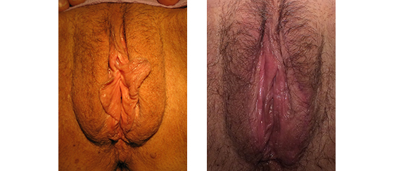 Labiaplasty minora and majora- This vulvar rejuvenation was the Winner of the 2020 ISCG (International Society of Cosmetogynecologists) Award for Best Labia Minoraplasty + Majoraplasty